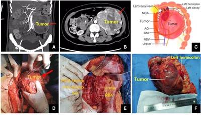 Unusually large paraganglioma complicated with successive catecholamine crises: A case report and review of the literature